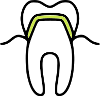 Dental restoration
